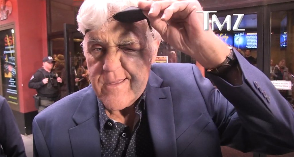 Jay Leno wearing an eyepatch with a bruise on his face.