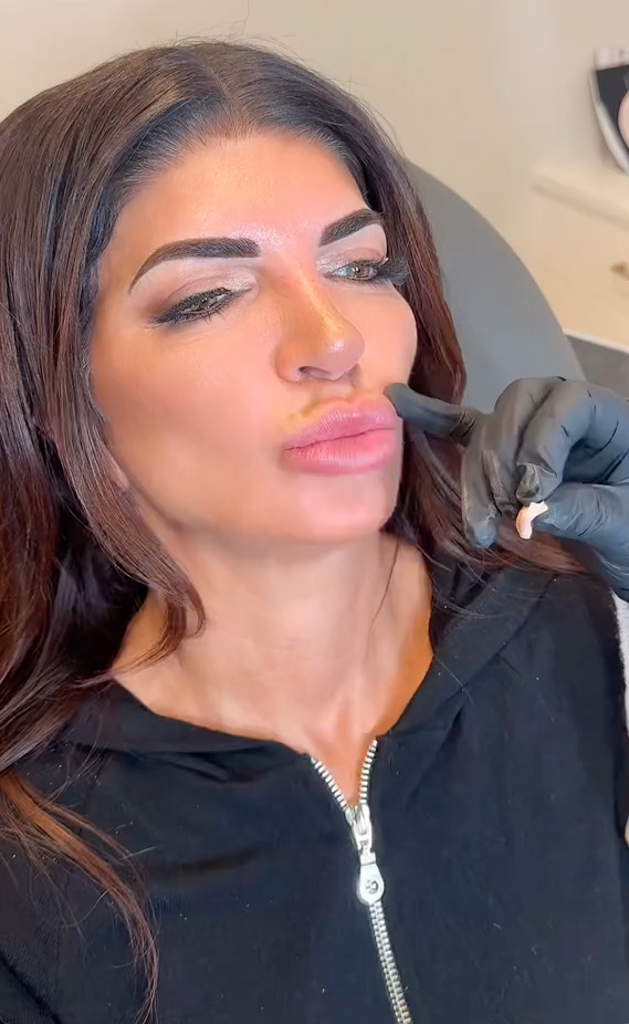 Teresa Giudice getting her lip filler dissolved