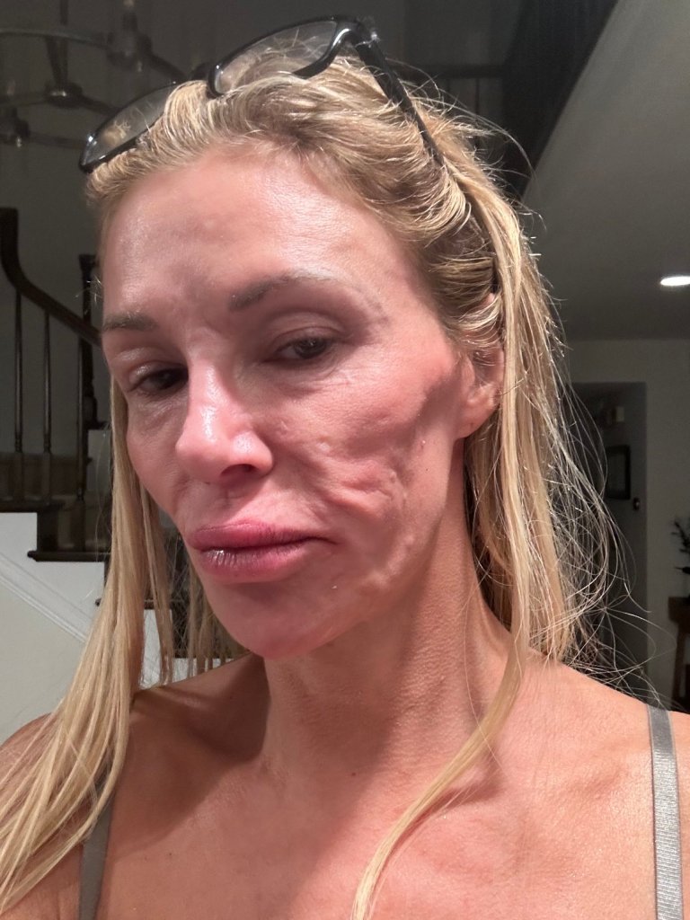 Brandi Glanville shows off facial in a photo posted to X on Saturday.