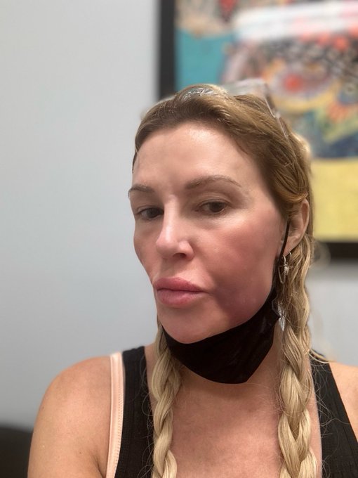 Brandi Glanville with a swollen face.