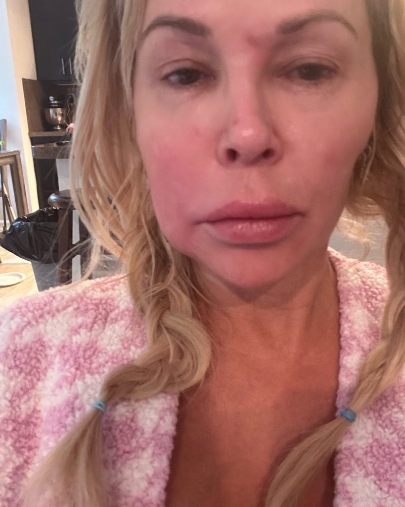 Brandi Glanville face swollen